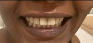 Teeth before whitening treatment at Best Laser Room Chelsea