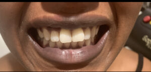 Teeth after laser whitening treatment at Best Laser Room Chelsea