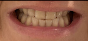 Before teeth whitening — patient 2