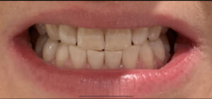 After teeth whitening — patient 2
